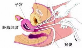 人流手术在线观看,在线观看带你深入了解